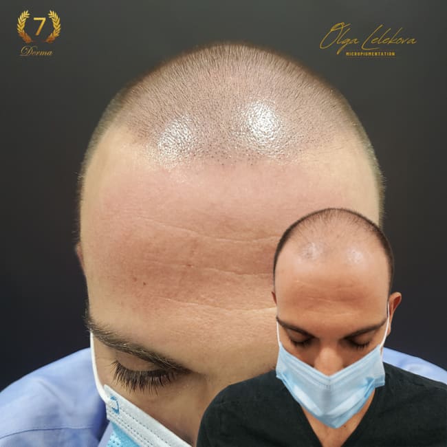 Scalp Micropigmentation Dubai: In loving memory of Olga Lelekova Dubai smp
