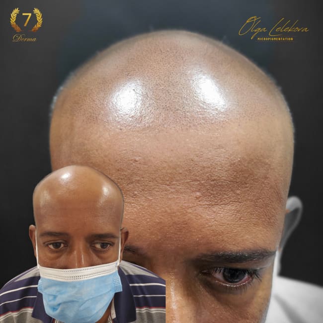 Scalp Micropigmentation Dubai: In loving memory of Olga Lelekova Smp dubai
