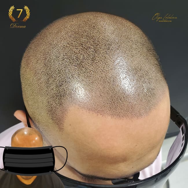 Scalp Micropigmentation Dubai: In loving memory of Olga Lelekova scalp microblading