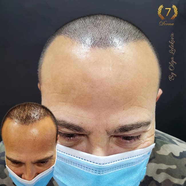 Scalp Micropigmentation Dubai: In loving memory of Olga Lelekova hair tattoo dubai