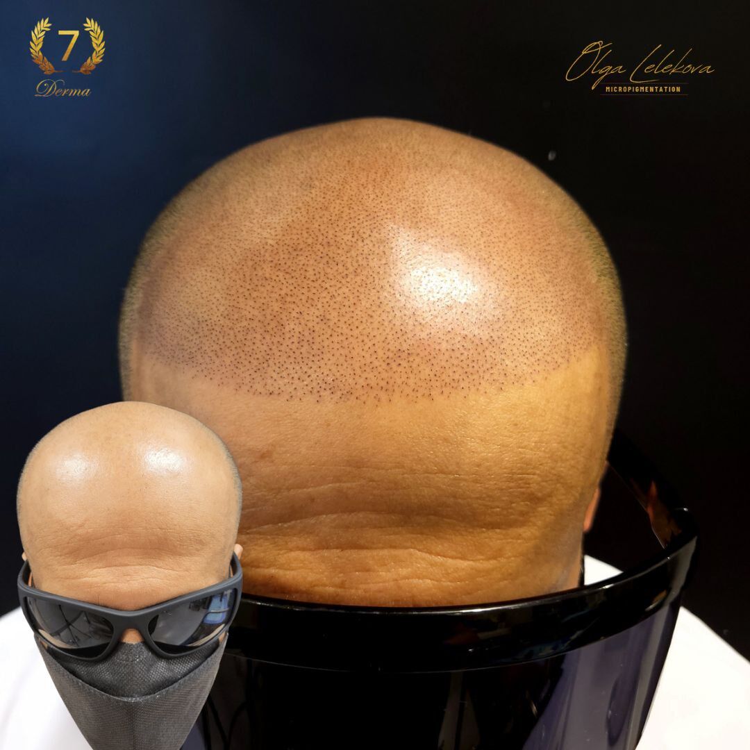 Scalp Micropigmentation Dubai: In loving memory of Olga Lelekova round hairline smp result