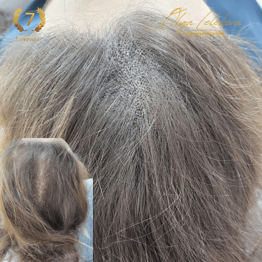 Scalp Micropigmentation Dubai: In loving memory of Olga Lelekova hair density smp result woman