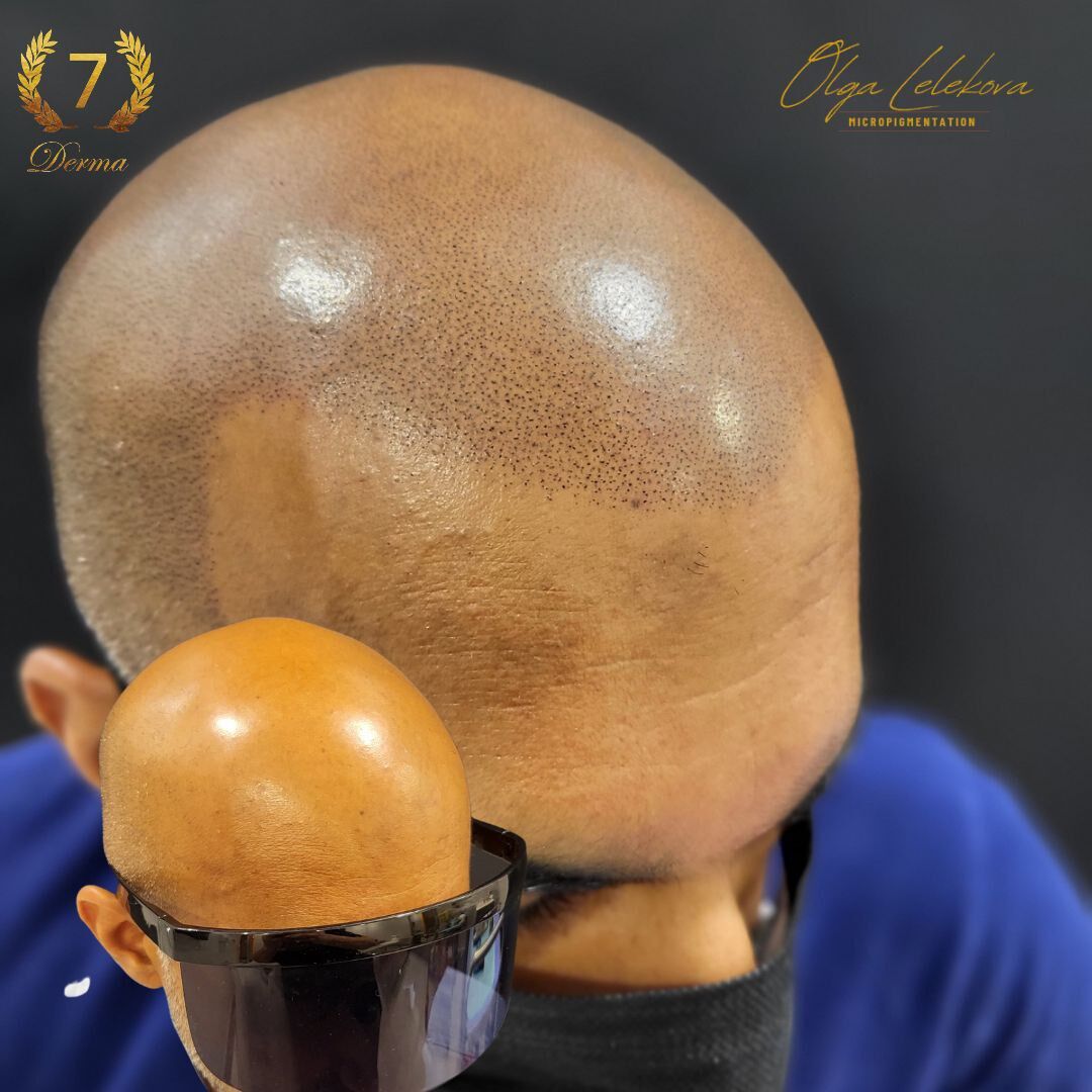 Scalp Micropigmentation Dubai: In loving memory of Olga Lelekova SMP result by Olga Lelekova
