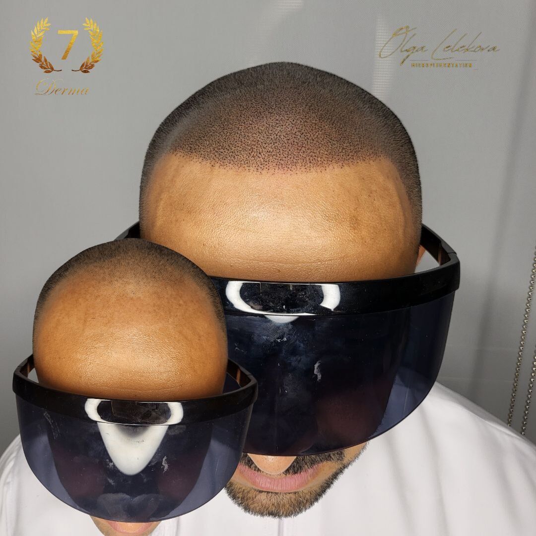 Scalp Micropigmentation Dubai: In loving memory of Olga Lelekova Scalp Micropigmentation result by Olga Lelekova