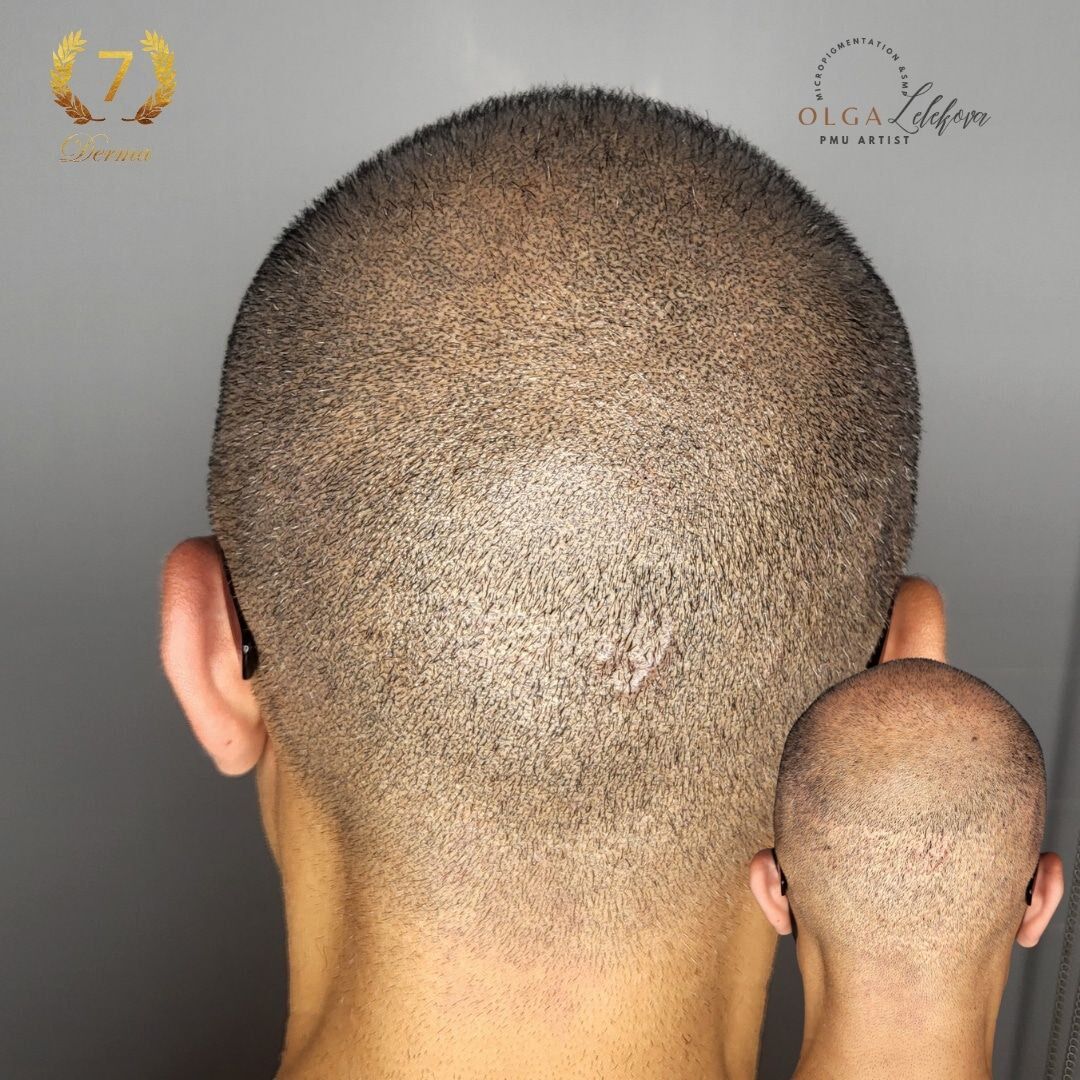 Scalp Micropigmentation Dubai: In loving memory of Olga Lelekova scar smp result