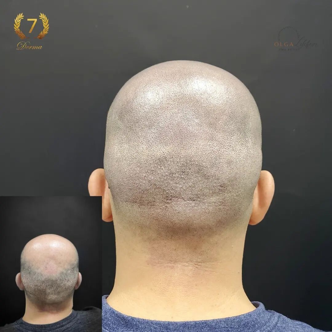 Scalp Micropigmentation Dubai: In loving memory of Olga Lelekova smp scar camouflage result