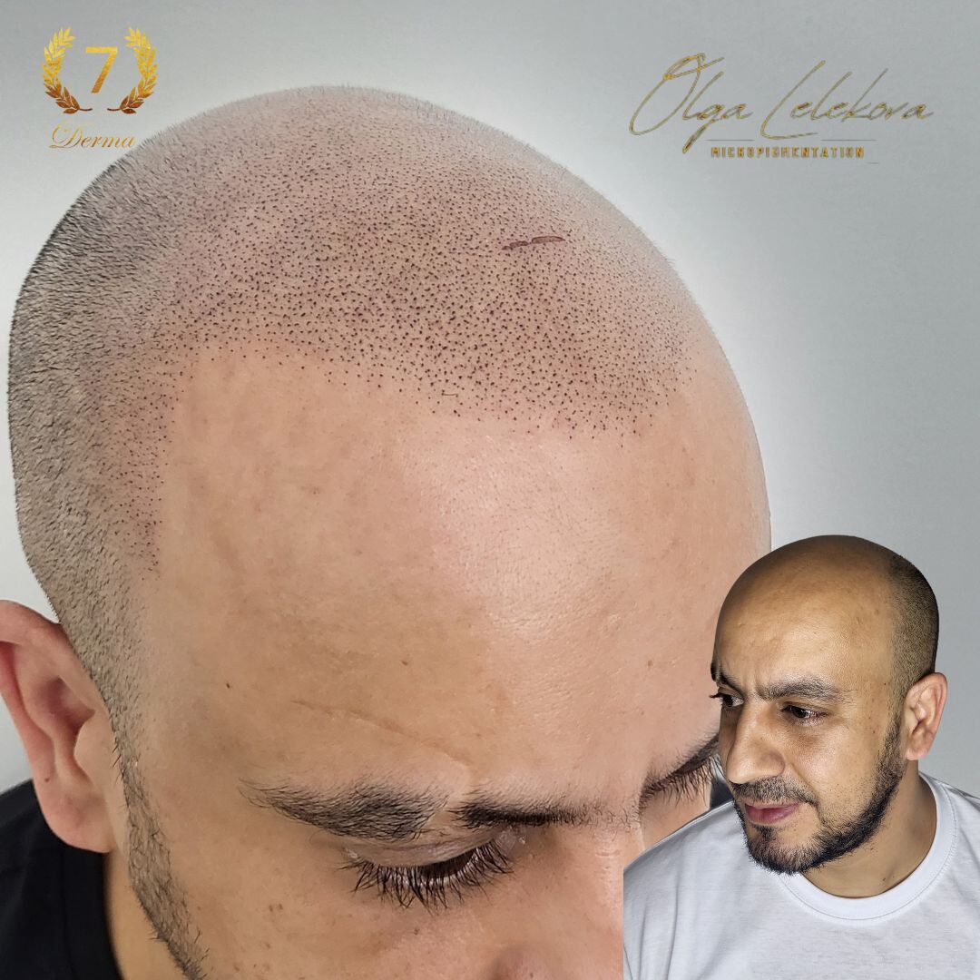 Scalp Micropigmentation Dubai: In loving memory of Olga Lelekova curved hairline smp result