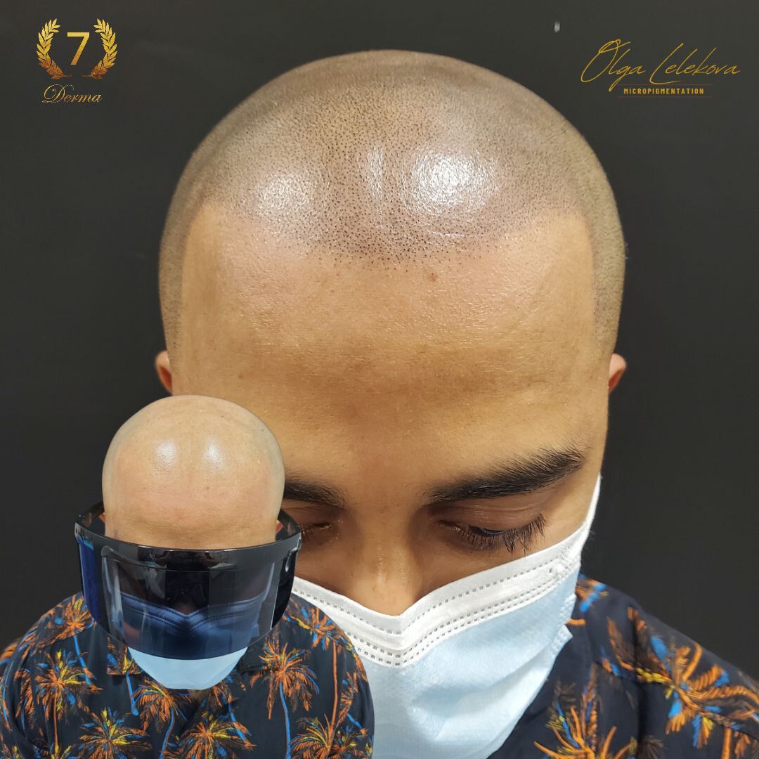 Scalp Micropigmentation Dubai: In loving memory of Olga Lelekova androgenic alopecia smp result