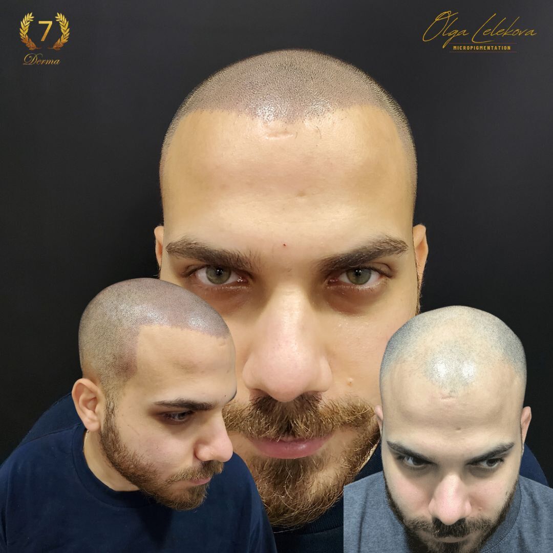 Scalp Micropigmentation Dubai: In loving memory of Olga Lelekova balding scalp smp rsult