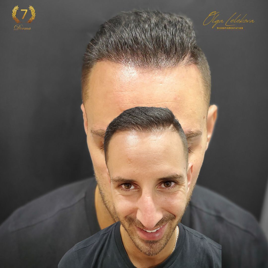 Scalp Micropigmentation Dubai: In loving memory of Olga Lelekova smp hair density result