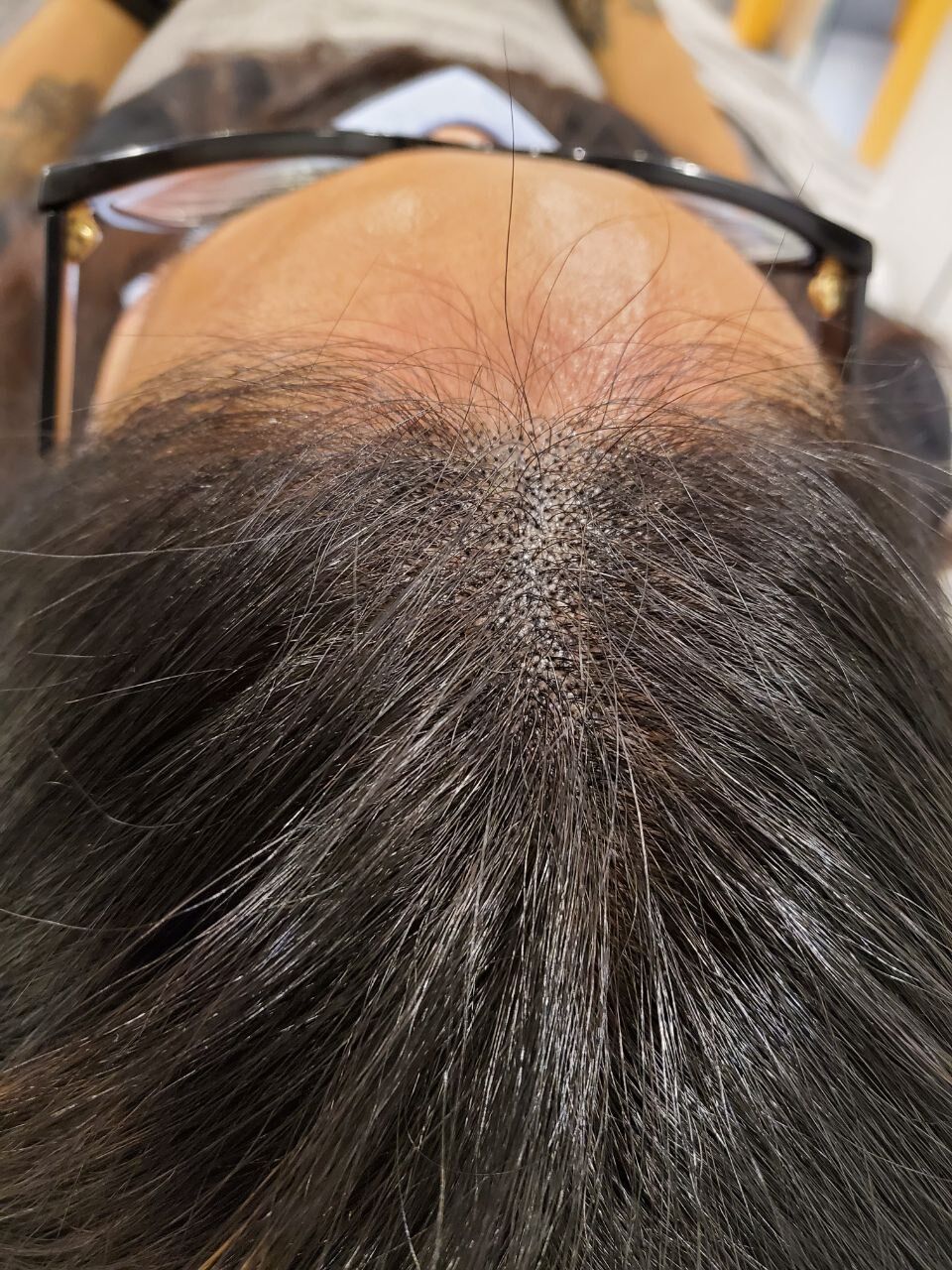 Scalp Micropigmentation Dubai: In loving memory of Olga Lelekova female smp result