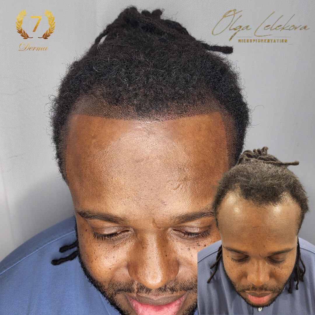 Scalp Micropigmentation Dubai: In loving memory of Olga Lelekova smp result dubai