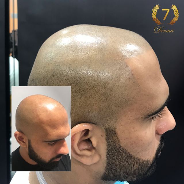 Scalp Micropigmentation Dubai: In loving memory of Olga Lelekova SMP results