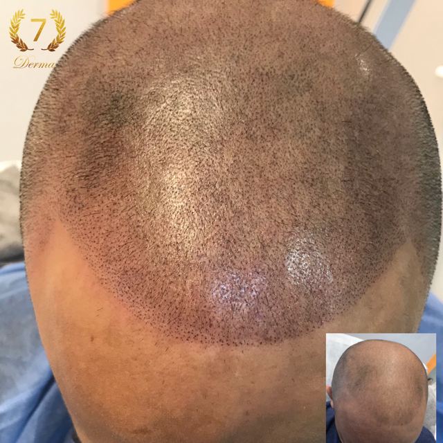 Scalp Micropigmentation Dubai: In loving memory of Olga Lelekova SMP before and after
