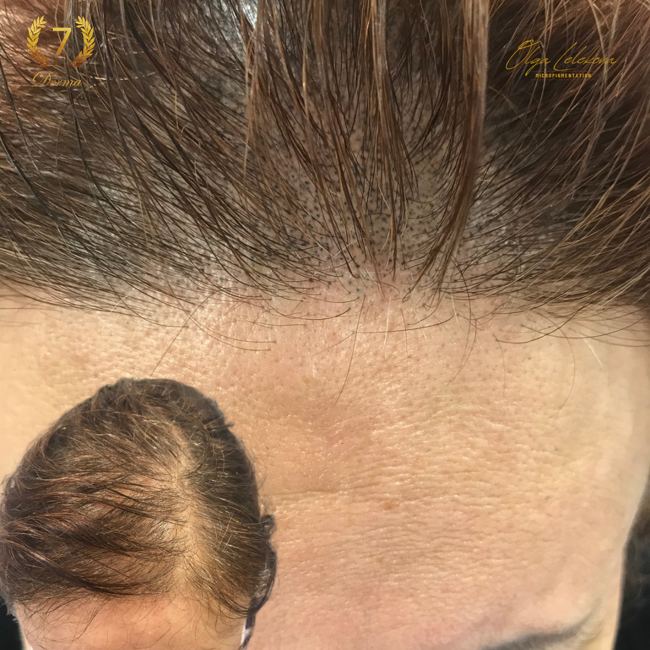 Scalp Micropigmentation Dubai: In loving memory of Olga Lelekova female hairline smp