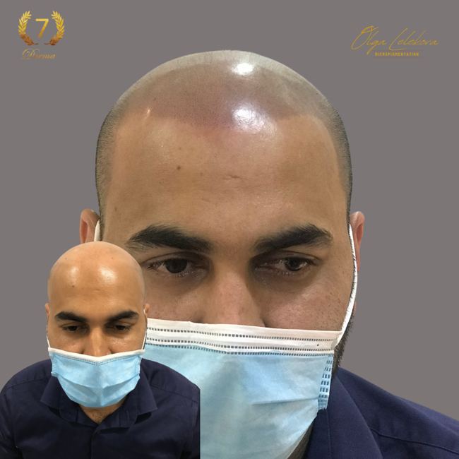 Scalp Micropigmentation Dubai: In loving memory of Olga Lelekova razor shaved smp