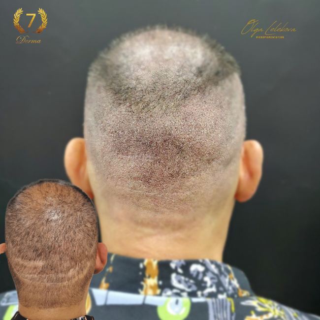 Scalp Micropigmentation Dubai: In loving memory of Olga Lelekova balding patches smp