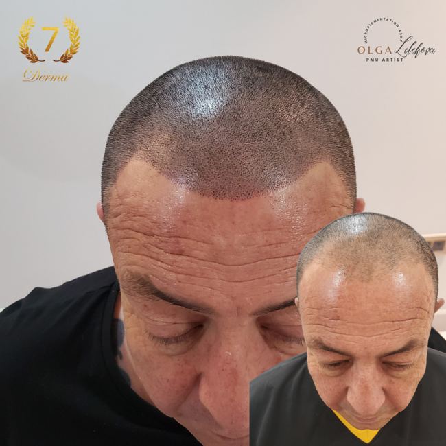 Scalp Micropigmentation Dubai: In loving memory of Olga Lelekova full scalp smp