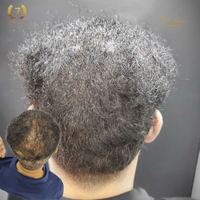 Scalp Micropigmentation Dubai: In loving memory of Olga Lelekova long hair smp