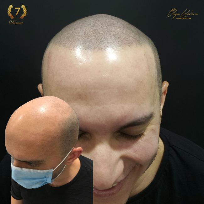 Scalp Micropigmentation Dubai: In loving memory of Olga Lelekova top head smp