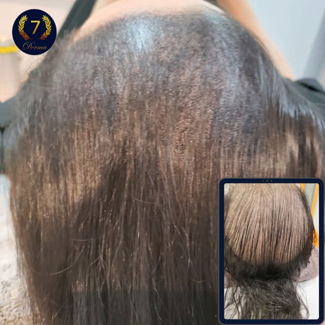 Scalp Micropigmentation Dubai: In loving memory of Olga Lelekova smp long hair