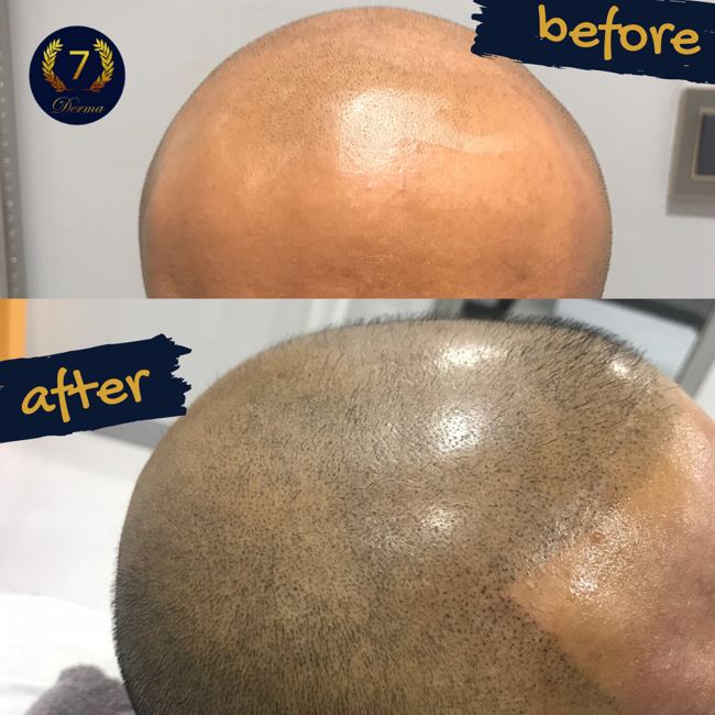 Scalp Micropigmentation Dubai: In loving memory of Olga Lelekova Before and after results SMP 7 Derma