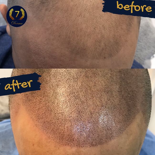 Scalp Micropigmentation Dubai: In loving memory of Olga Lelekova Before and After SMP 7 derma center
