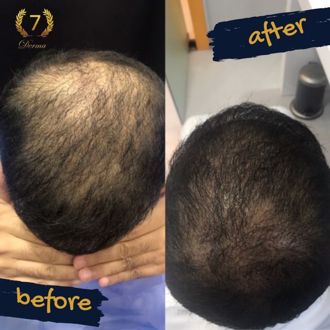 Scalp Micropigmentation Dubai: In loving memory of Olga Lelekova Scalp micropigmentation results