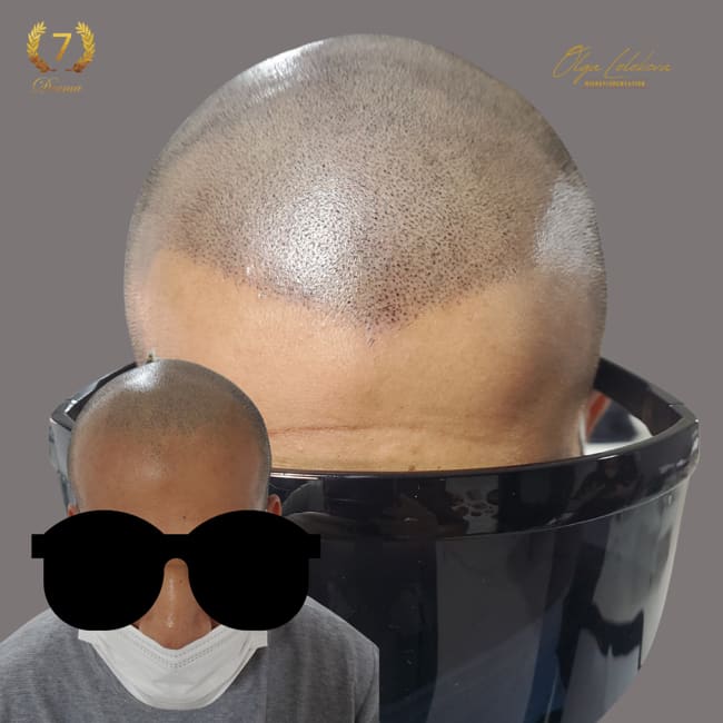 Scalp Micropigmentation Dubai: In loving memory of Olga Lelekova scalp tattoo dubai