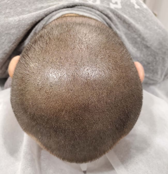 Scalp Micropigmentation Dubai: In loving memory of Olga Lelekova scalp tattoo repair