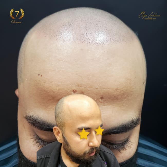 Scalp Micropigmentation Dubai: In loving memory of Olga Lelekova smp result