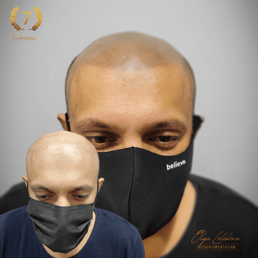 Scalp Micropigmentation Dubai: In loving memory of Olga Lelekova smp perfect results