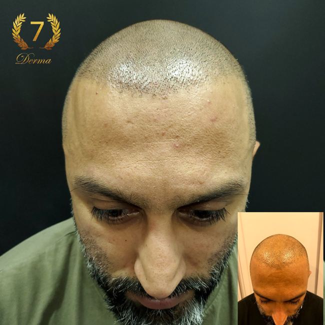 Scalp Micropigmentation Dubai: In loving memory of Olga Lelekova smp results