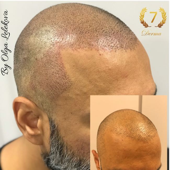 Scalp Micropigmentation Dubai: In loving memory of Olga Lelekova scalp micropigmentation at 7 derma