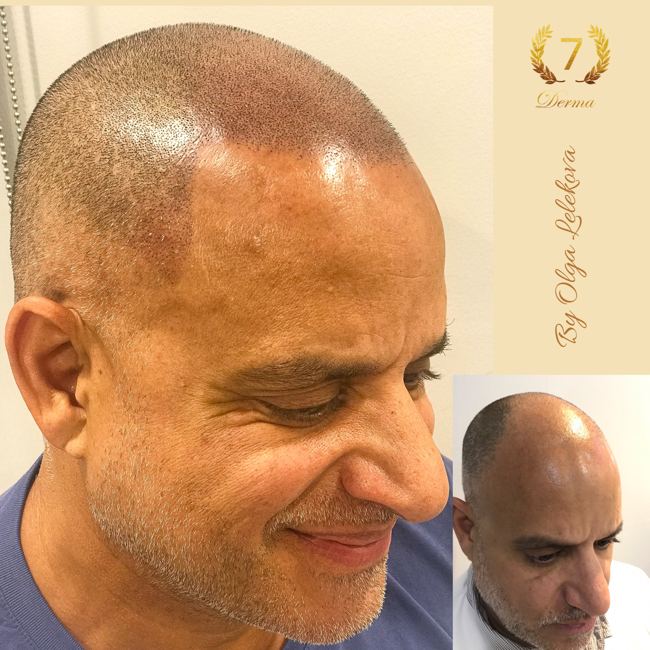 Scalp Micropigmentation Dubai: In loving memory of Olga Lelekova smp dubai at 7 derma