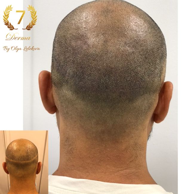 Scalp Micropigmentation Dubai: In loving memory of Olga Lelekova scar camouflage smp