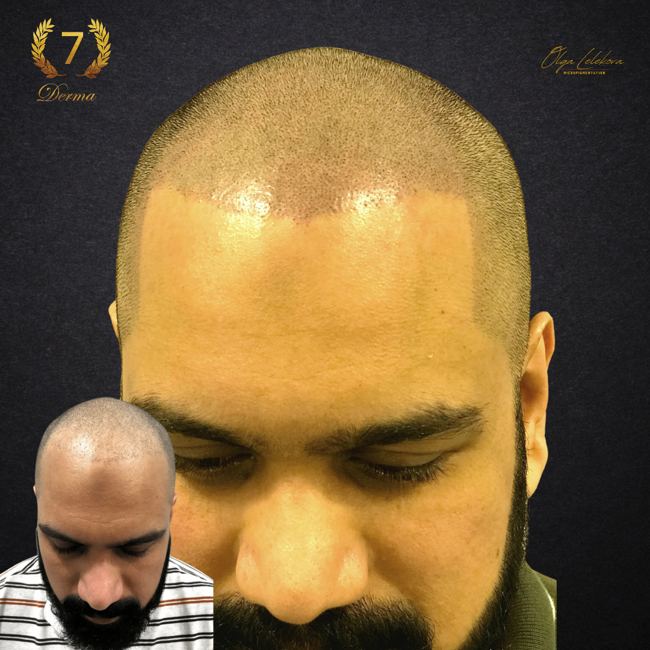 Scalp Micropigmentation Dubai: In loving memory of Olga Lelekova smp before and after