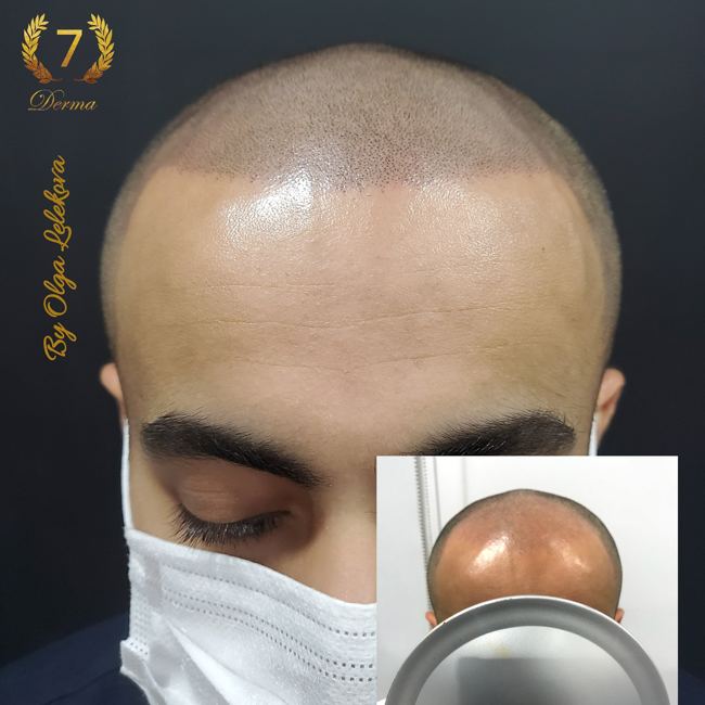 Scalp Micropigmentation Dubai: In loving memory of Olga Lelekova scalp micropigmentation with olga