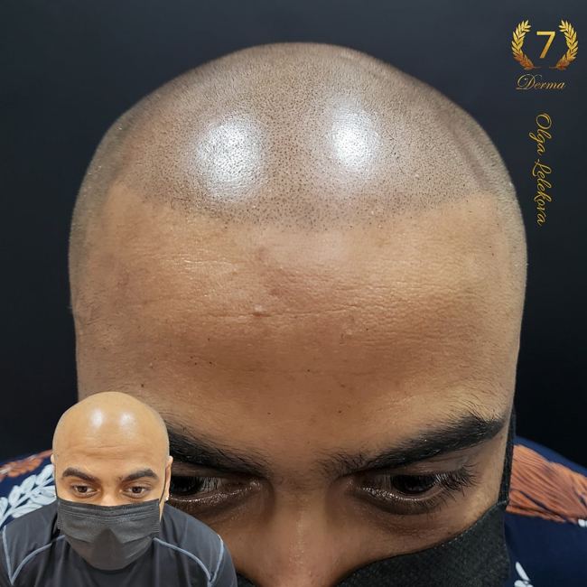 Scalp Micropigmentation Dubai: In loving memory of Olga Lelekova scalp micropigmentation dubai 7 derma center