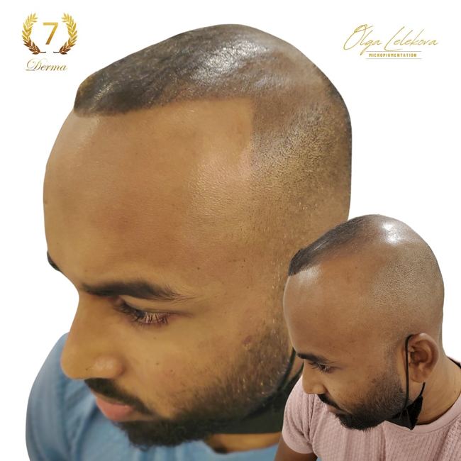 Scalp Micropigmentation Dubai: In loving memory of Olga Lelekova smp dubai olga
