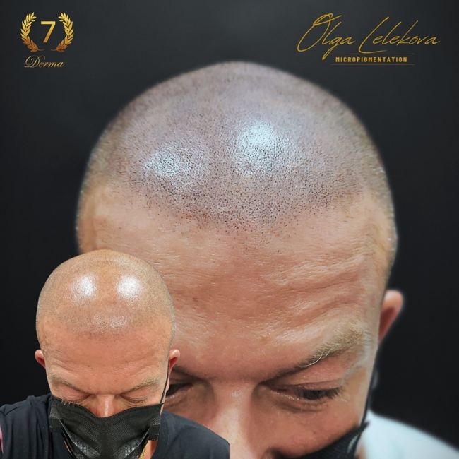 Scalp Micropigmentation Dubai: In loving memory of Olga Lelekova smp success
