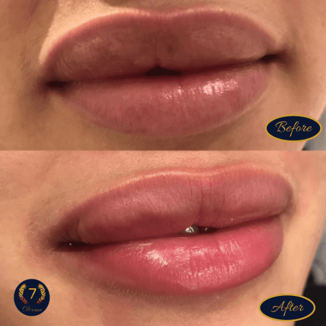 does glutathione lighten lips Skin Whitening Injection (NAC) In Dubai Vitaminas Peptide Therapy Ocoee, FL Color:Black / Silver - Vinyl