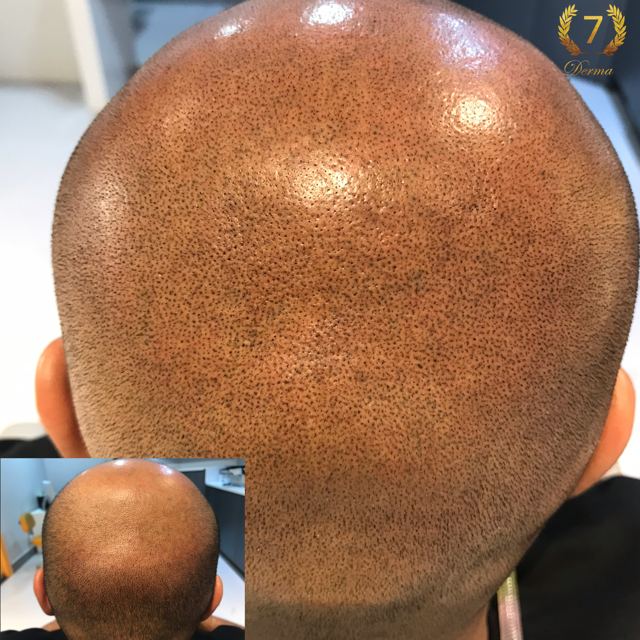Scalp Micropigmentation Dubai: In loving memory of Olga Lelekova Scalp Micropigmentation by Olga Lelekova